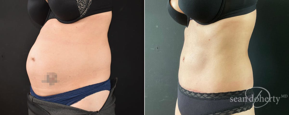 Abdominoplasty (Tummy Tuck) Before & After Gallery - Patient 205159 - Image 2