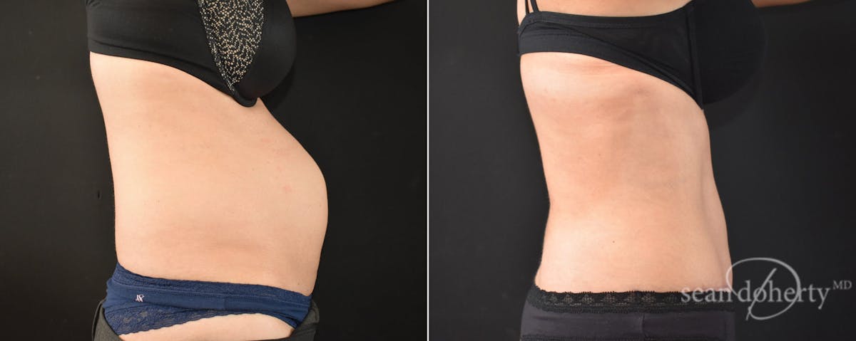 Abdominoplasty (Tummy Tuck) Before & After Gallery - Patient 205159 - Image 3