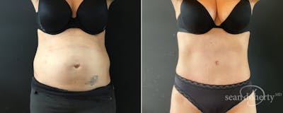 Abdominoplasty (Tummy Tuck) Before & After Gallery - Patient 205159 - Image 1