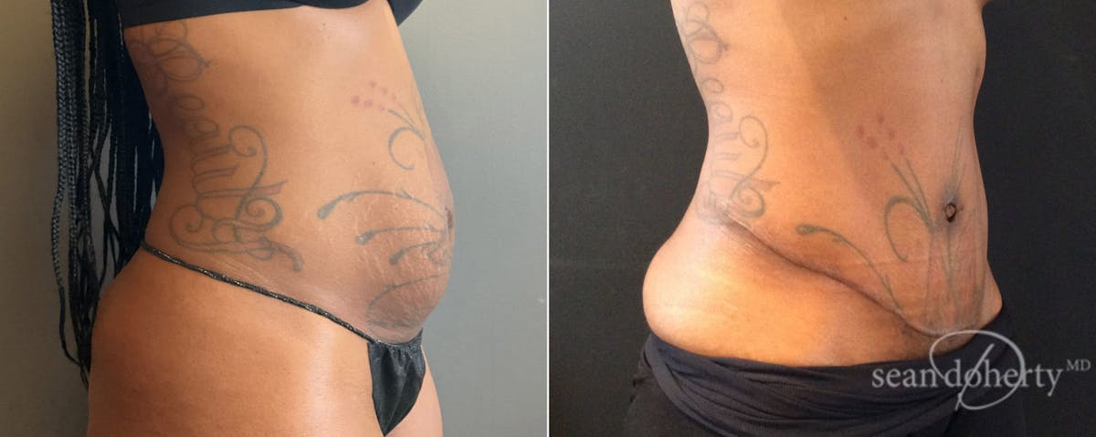 Abdominoplasty (Tummy Tuck) Before & After Gallery - Patient 232347 - Image 2
