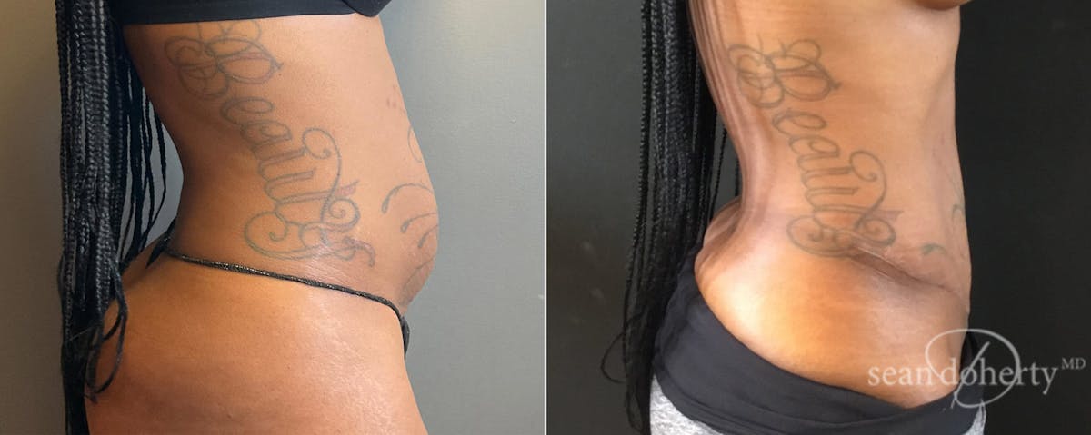 Abdominoplasty (Tummy Tuck) Before & After Gallery - Patient 232347 - Image 3