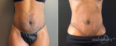 Abdominoplasty (Tummy Tuck) Before & After Gallery - Patient 232347 - Image 1