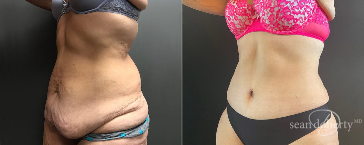 Abdominoplasty (Tummy Tuck) Before & After Gallery - Patient 171232 - Image 2