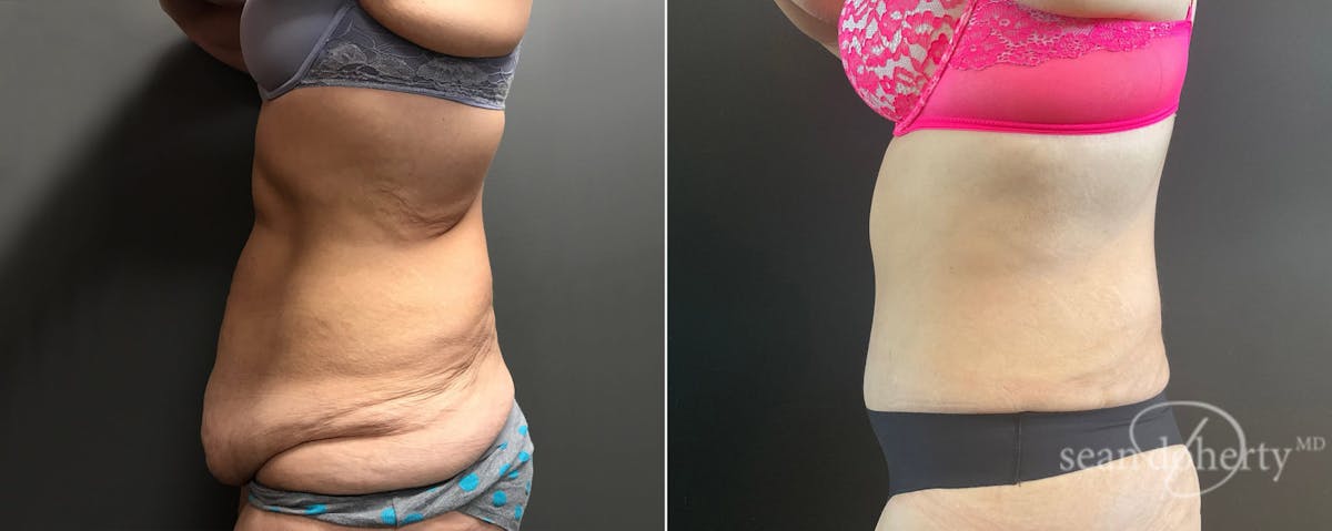 Abdominoplasty (Tummy Tuck) Before & After Gallery - Patient 171232 - Image 3