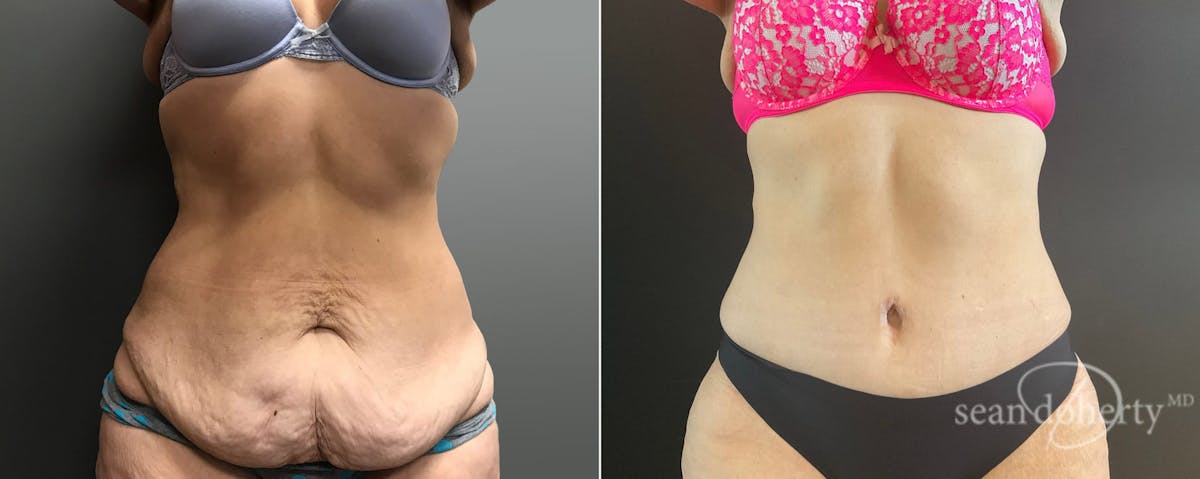 Abdominoplasty (Tummy Tuck) Before & After Gallery - Patient 171232 - Image 1