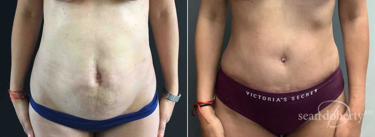 Abdominoplasty (Tummy Tuck) Before & After Gallery - Patient 289731 - Image 1