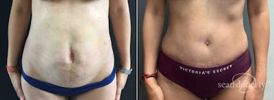 Abdominoplasty (Tummy Tuck) Before & After Gallery - Patient 289731 - Image 1