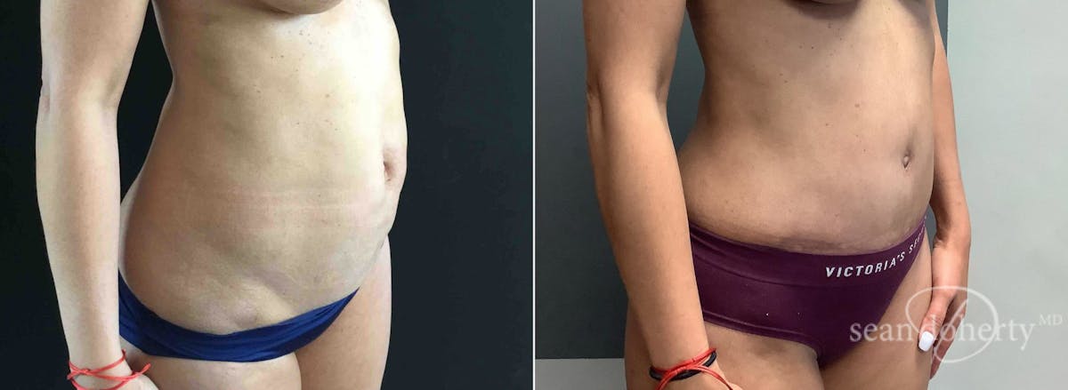 Abdominoplasty (Tummy Tuck) Before & After Gallery - Patient 289731 - Image 2