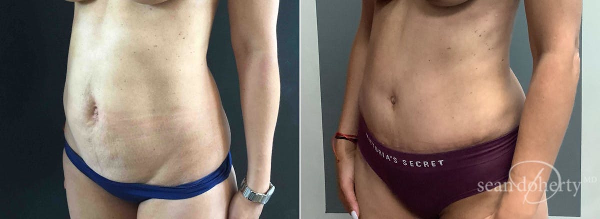 Abdominoplasty (Tummy Tuck) Before & After Gallery - Patient 289731 - Image 3