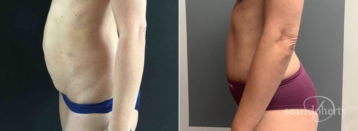 Abdominoplasty (Tummy Tuck) Before & After Gallery - Patient 289731 - Image 4