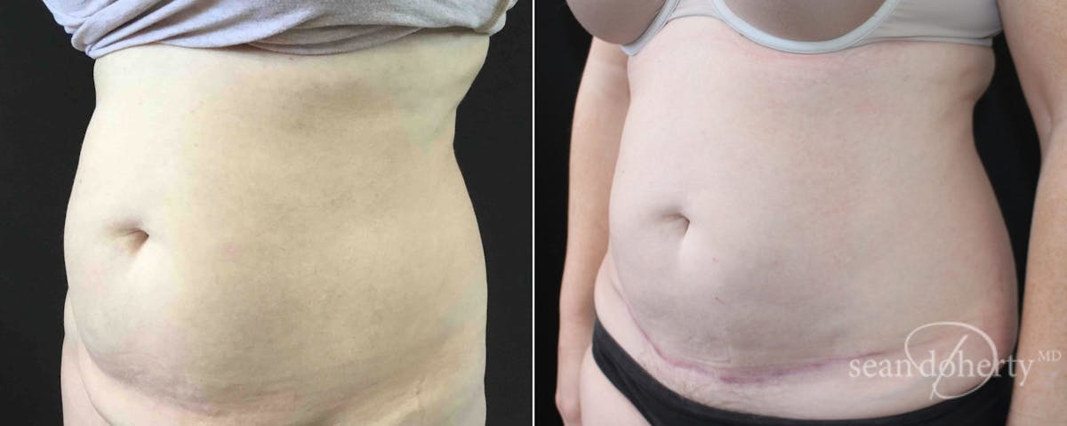 Abdominoplasty (Tummy Tuck) Before & After Gallery - Patient 396748 - Image 2