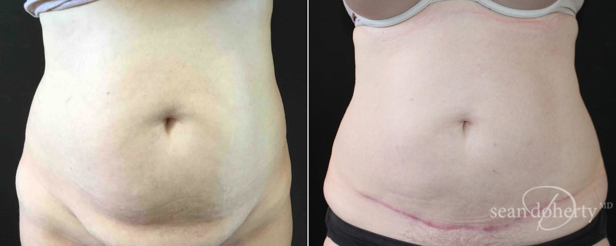 Abdominoplasty (Tummy Tuck) Before & After Gallery - Patient 396748 - Image 1