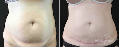 Abdominoplasty (Tummy Tuck) Before & After Gallery - Patient 396748 - Image 1