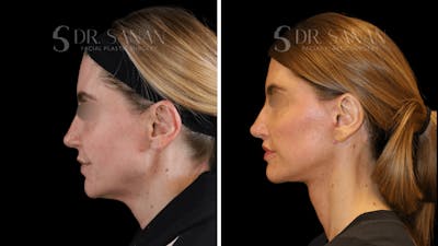 Neck Lift Before & After Gallery - Patient 605882 - Image 1