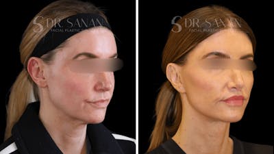 Deep Plane Facelift Before & After Gallery - Patient 210320 - Image 1