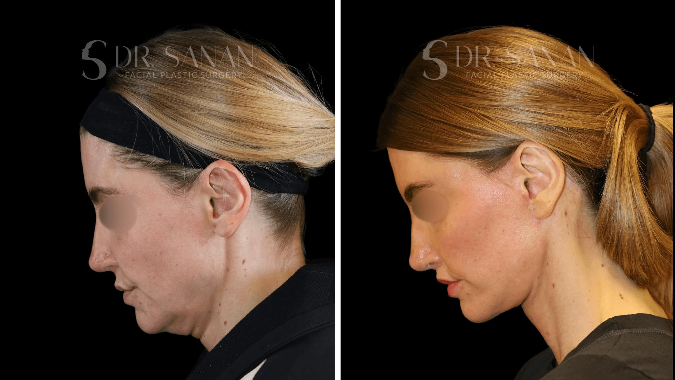 Fat Grafting Before & After Gallery - Patient 260511 - Image 7