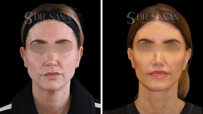 Neck Lift Before & After Gallery - Patient 605882 - Image 1