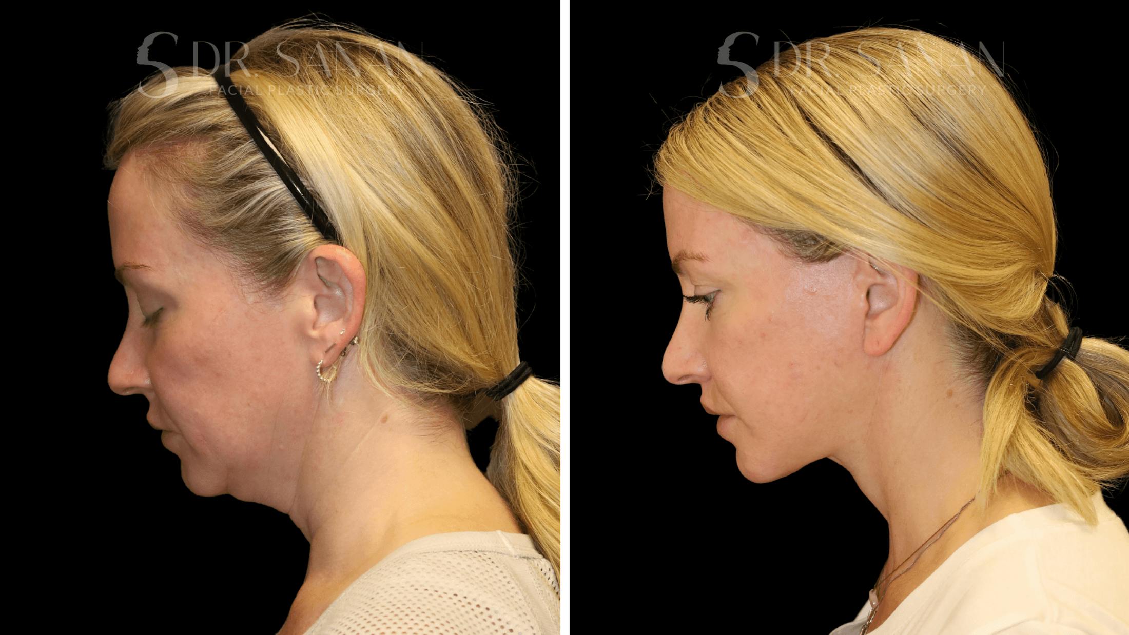 Fat Grafting Before & After Gallery - Patient 216492 - Image 10