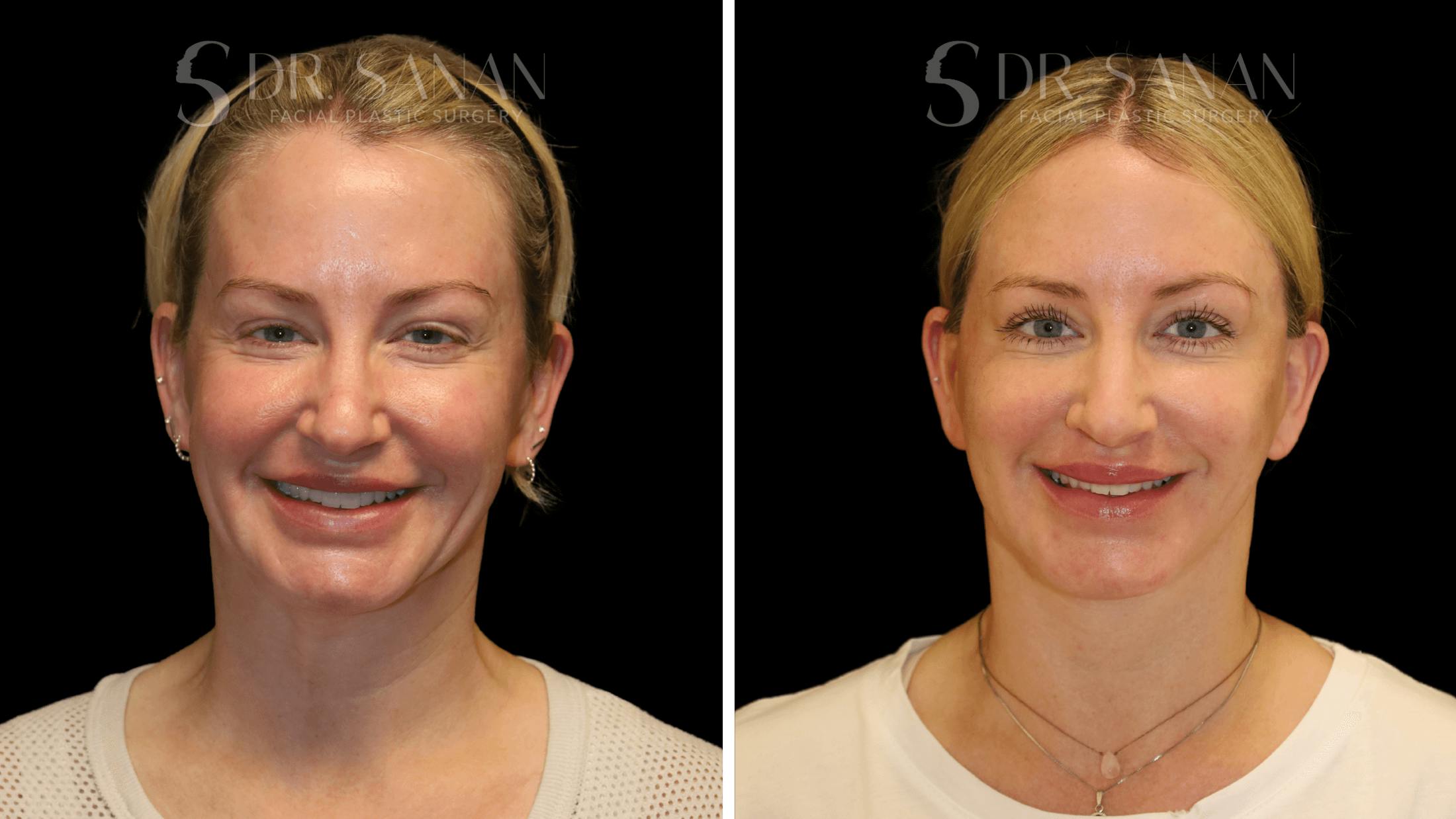 Fat Grafting Before & After Gallery - Patient 216492 - Image 2