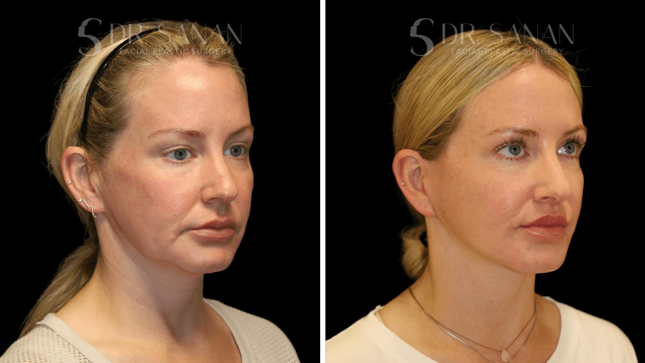 Fat Grafting Before & After Gallery - Patient 216492 - Image 3