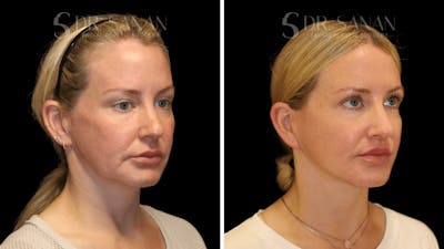 Deep Plane Facelift Before & After Gallery - Patient 286619 - Image 1