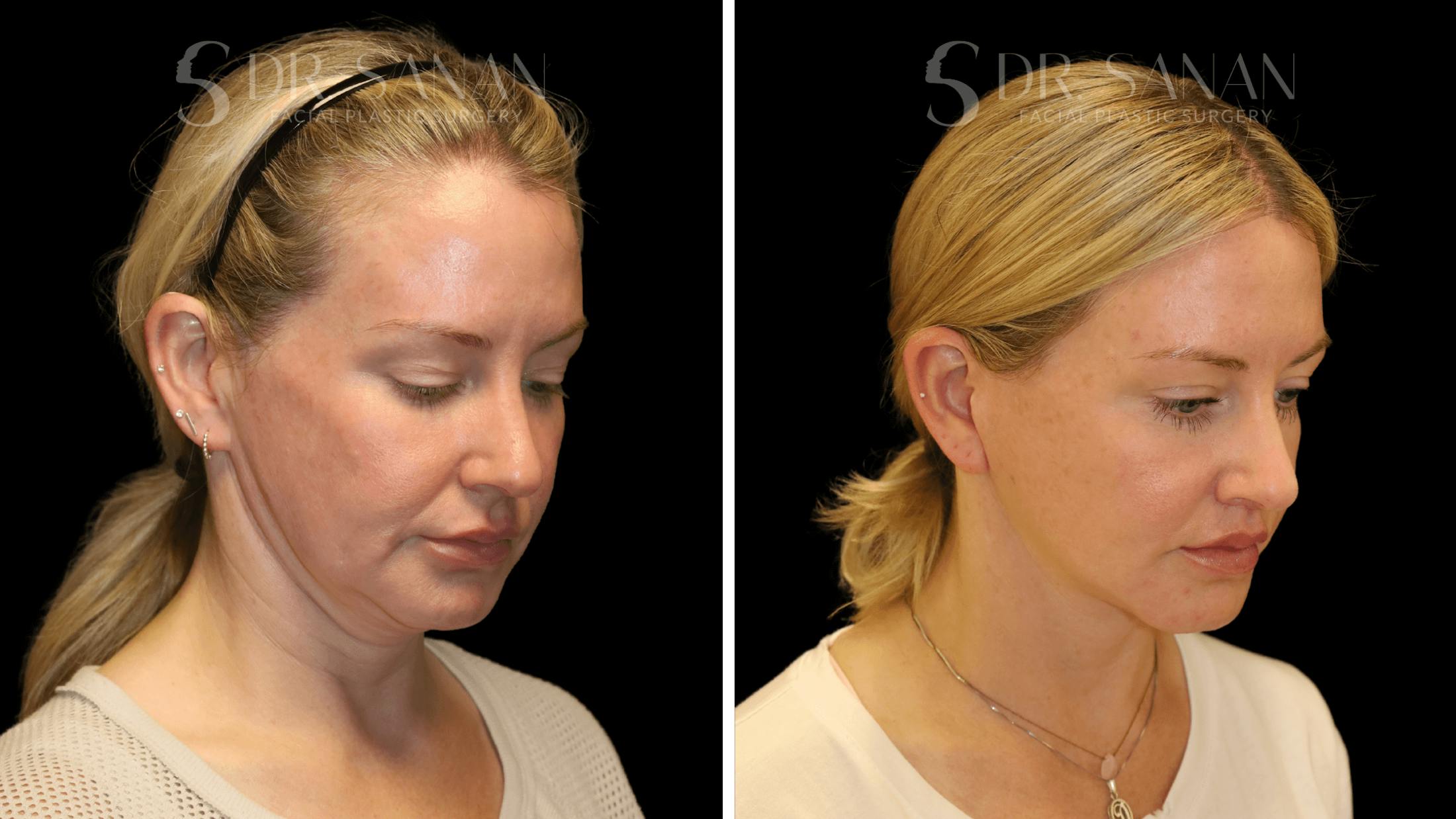 Fat Grafting Before & After Gallery - Patient 216492 - Image 4