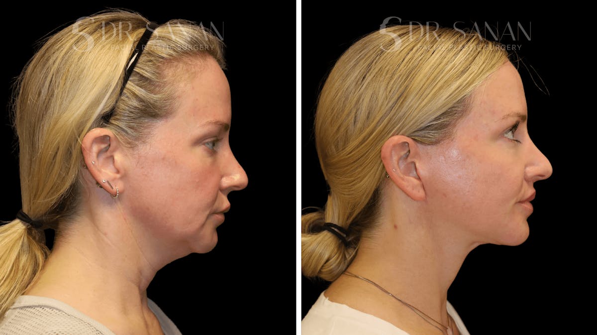 Fat Grafting Before & After Gallery - Patient 216492 - Image 5