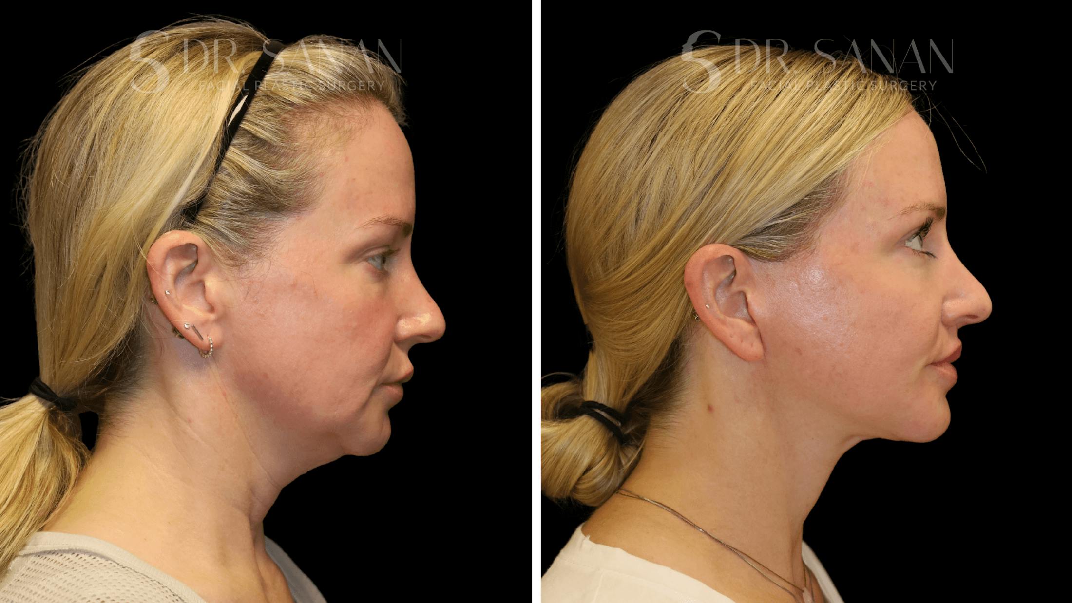 Fat Grafting Before & After Gallery - Patient 216492 - Image 5