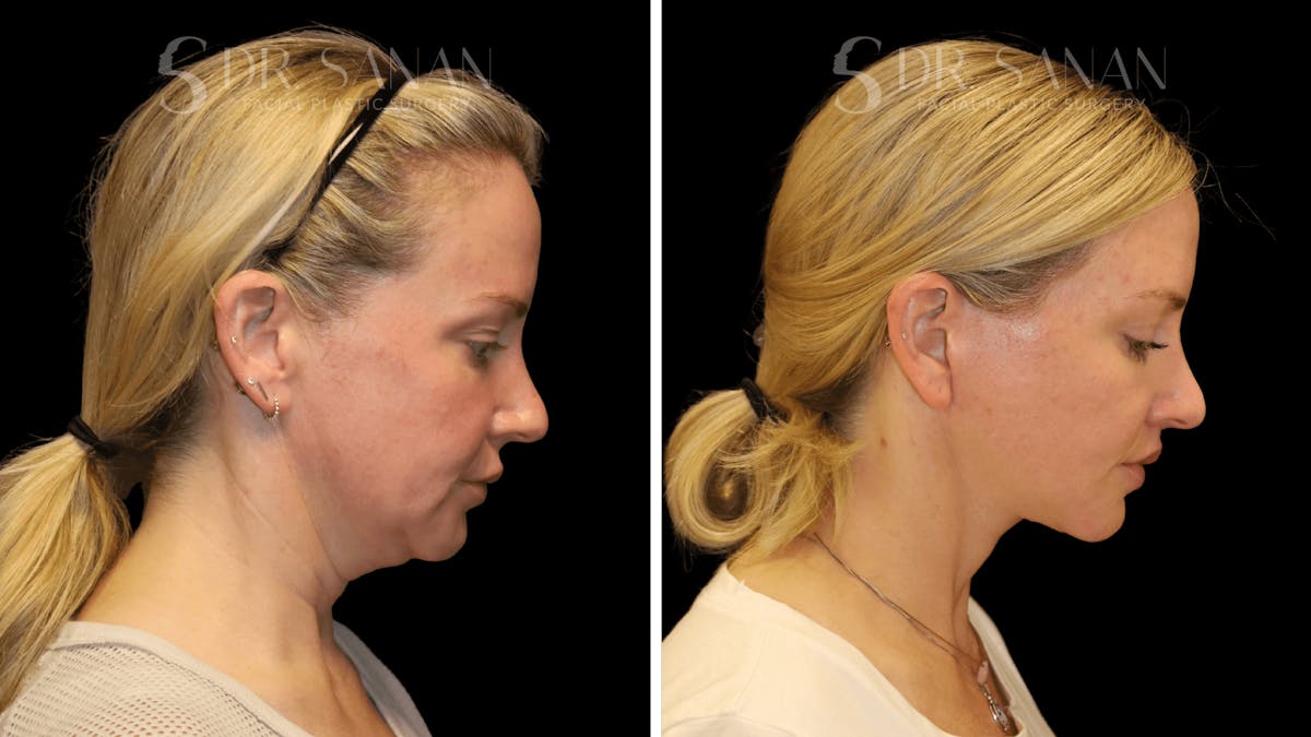 Fat Grafting Before & After Gallery - Patient 216492 - Image 6