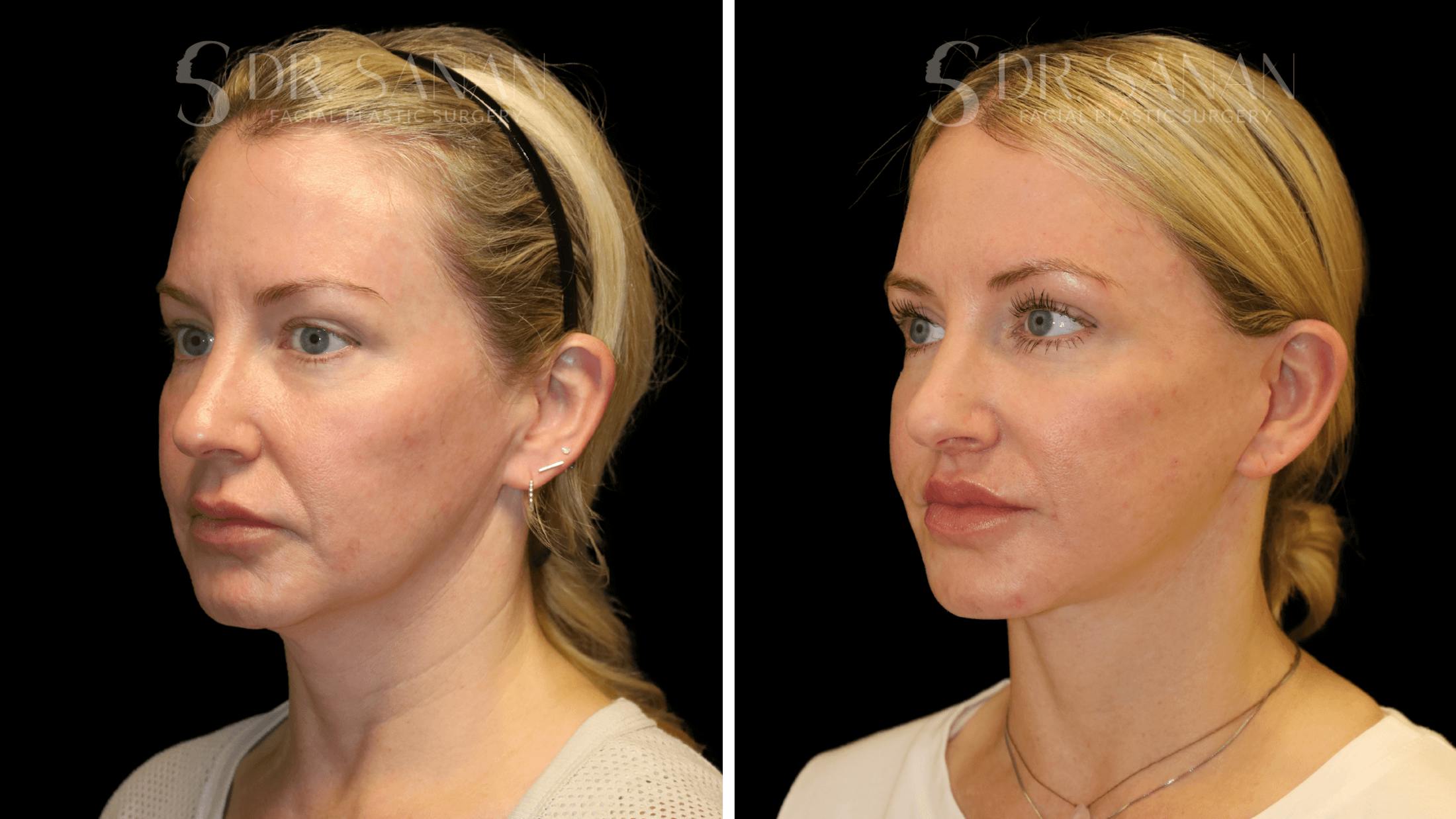 Fat Grafting Before & After Gallery - Patient 216492 - Image 7