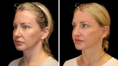 Deep Plane Facelift Before & After Gallery - Patient 286619 - Image 1