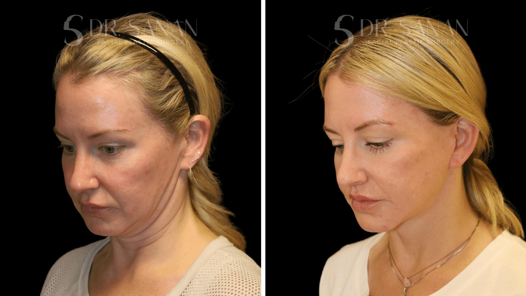 Fat Grafting Before & After Gallery - Patient 216492 - Image 8