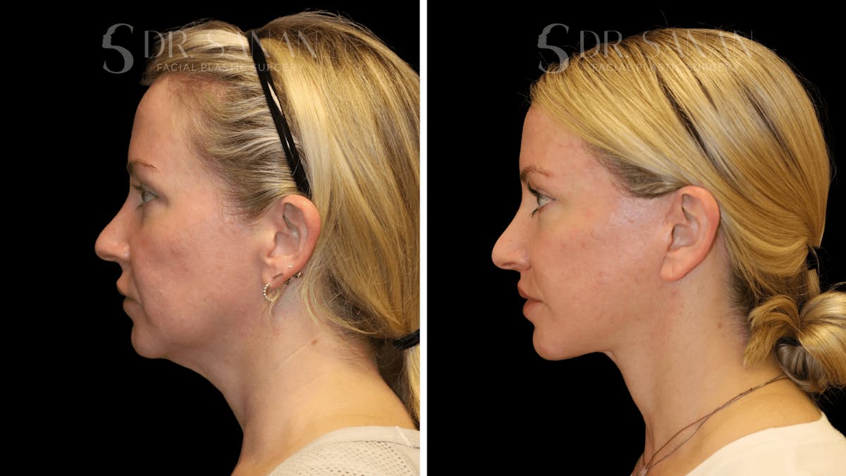 Fat Grafting Before & After Gallery - Patient 216492 - Image 9