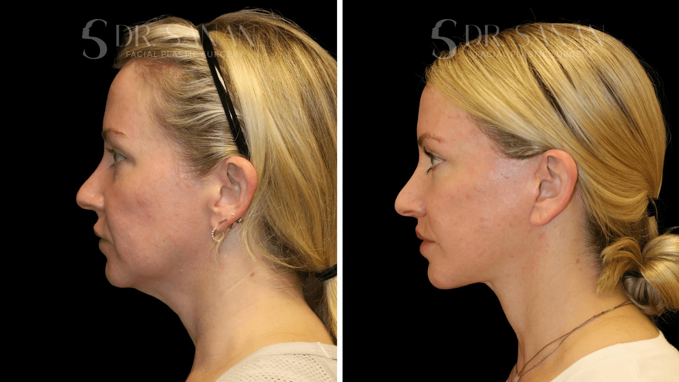 Fat Grafting Before & After Gallery - Patient 216492 - Image 9