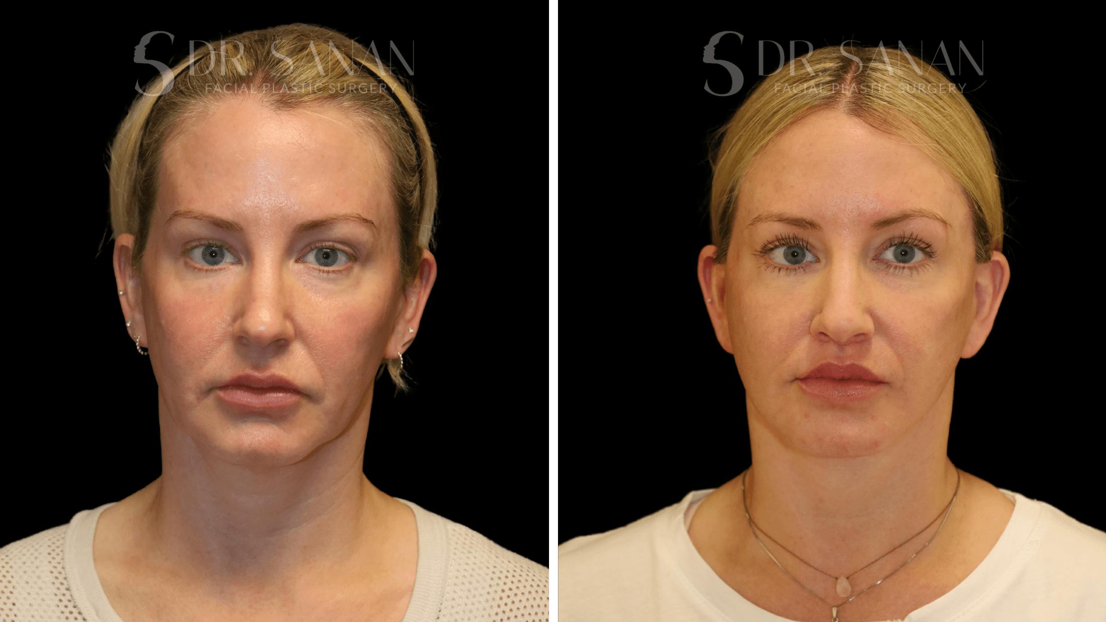 Fat Grafting Before & After Gallery - Patient 216492 - Image 1