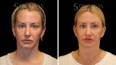 Neck Lift Before & After Gallery - Patient 321171 - Image 1