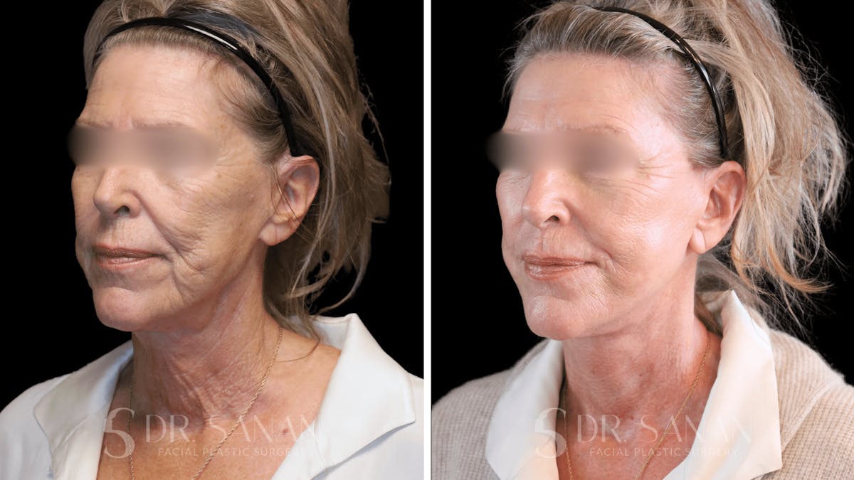 Neck Lift Before & After Gallery - Patient 102262 - Image 5