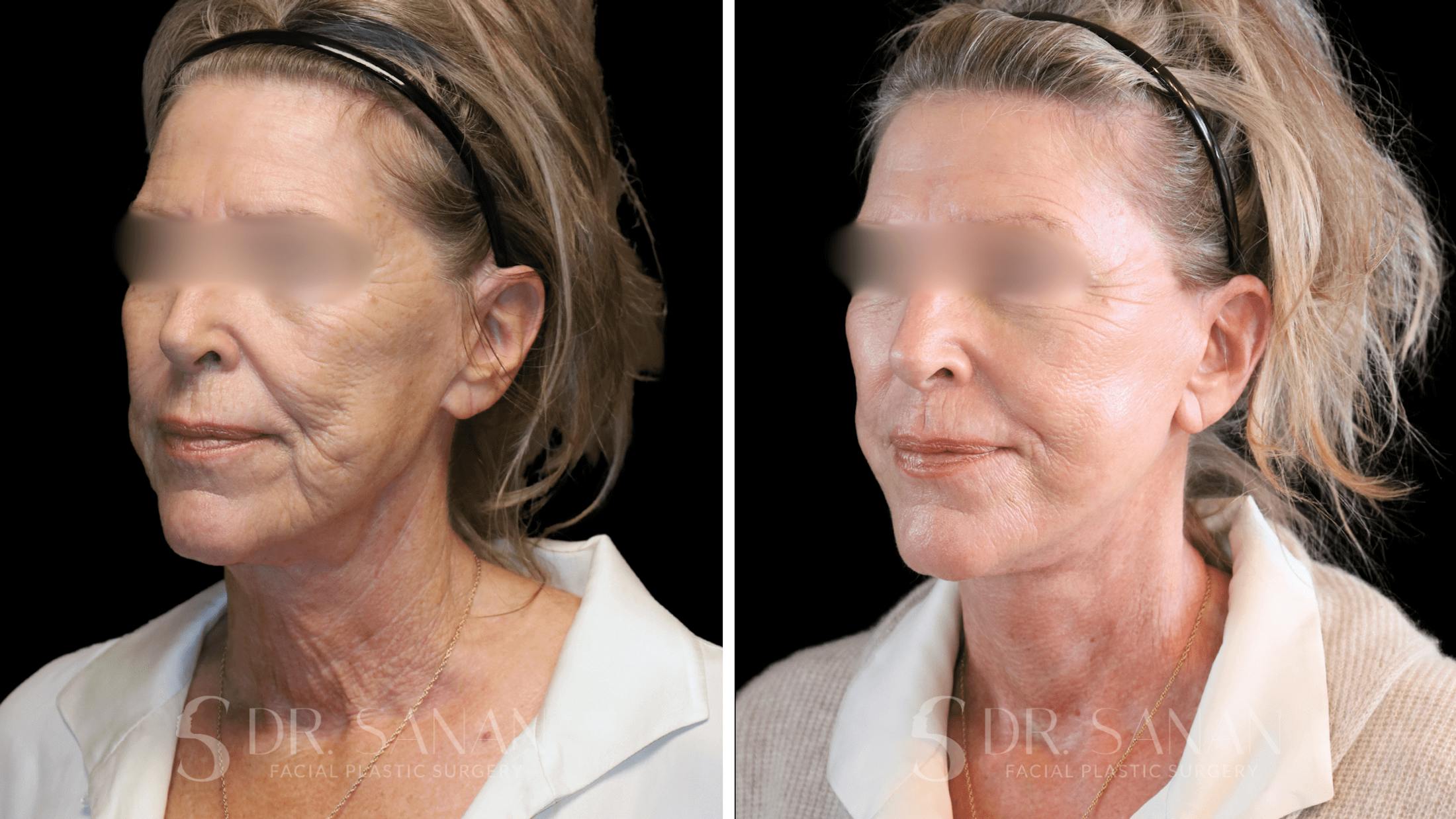 Neck Lift Before & After Gallery - Patient 102262 - Image 5