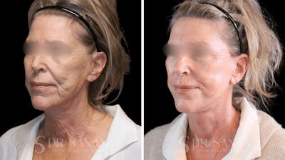Deep Plane Facelift Before & After Gallery - Patient 240419 - Image 1