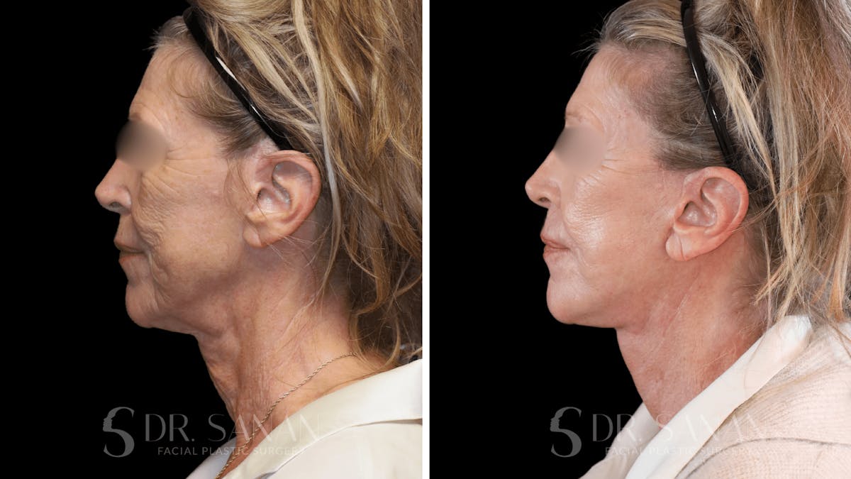 Neck Lift Before & After Gallery - Patient 102262 - Image 6