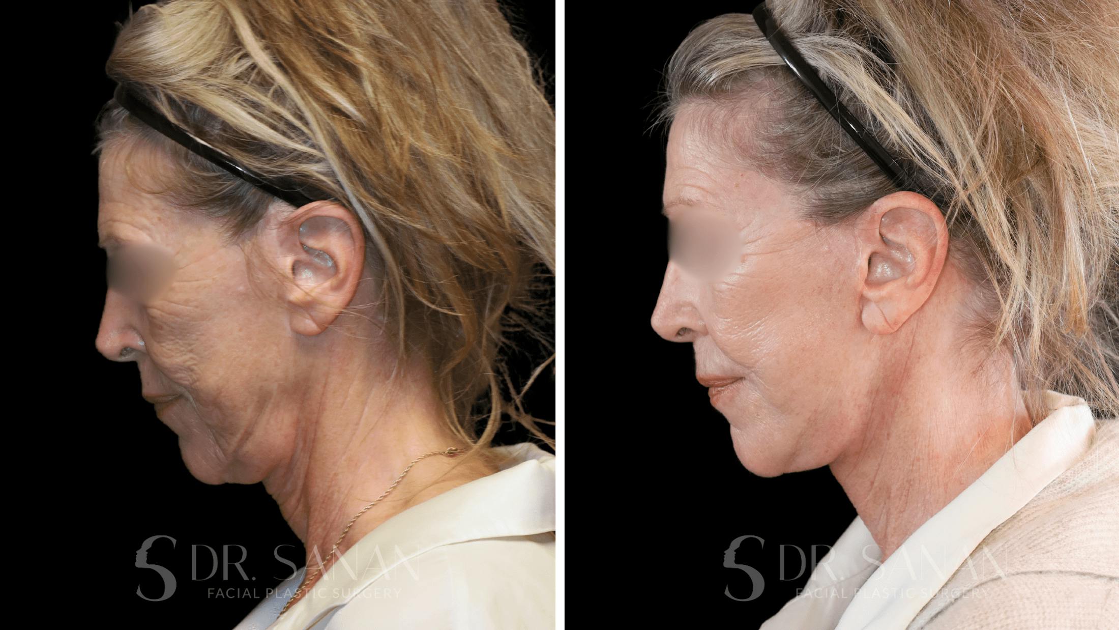 Neck Lift Before & After Gallery - Patient 102262 - Image 7