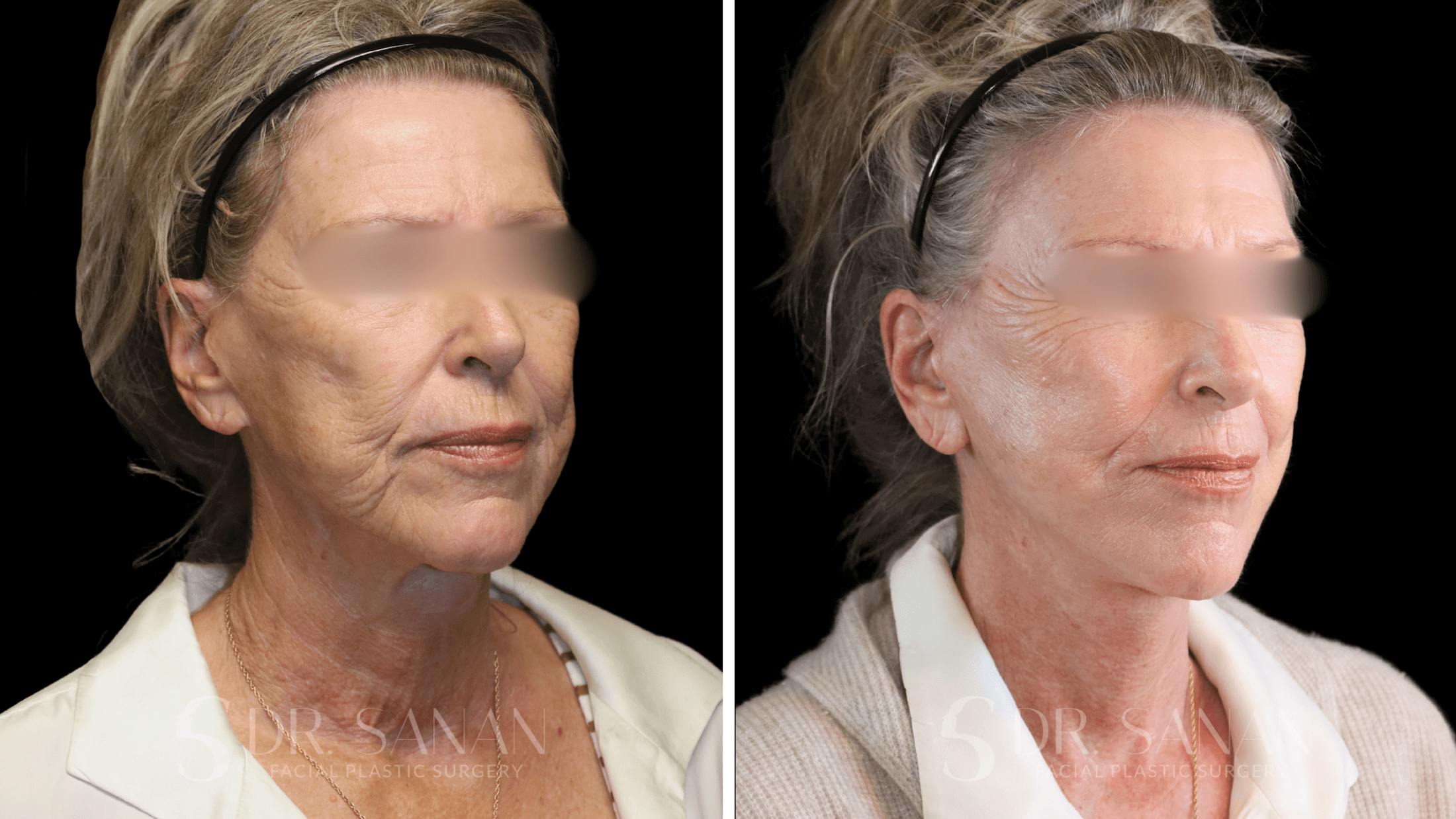 Neck Lift Before & After Gallery - Patient 102262 - Image 2