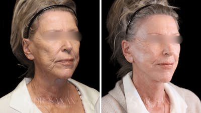 Deep Plane Facelift Before & After Gallery - Patient 240419 - Image 1