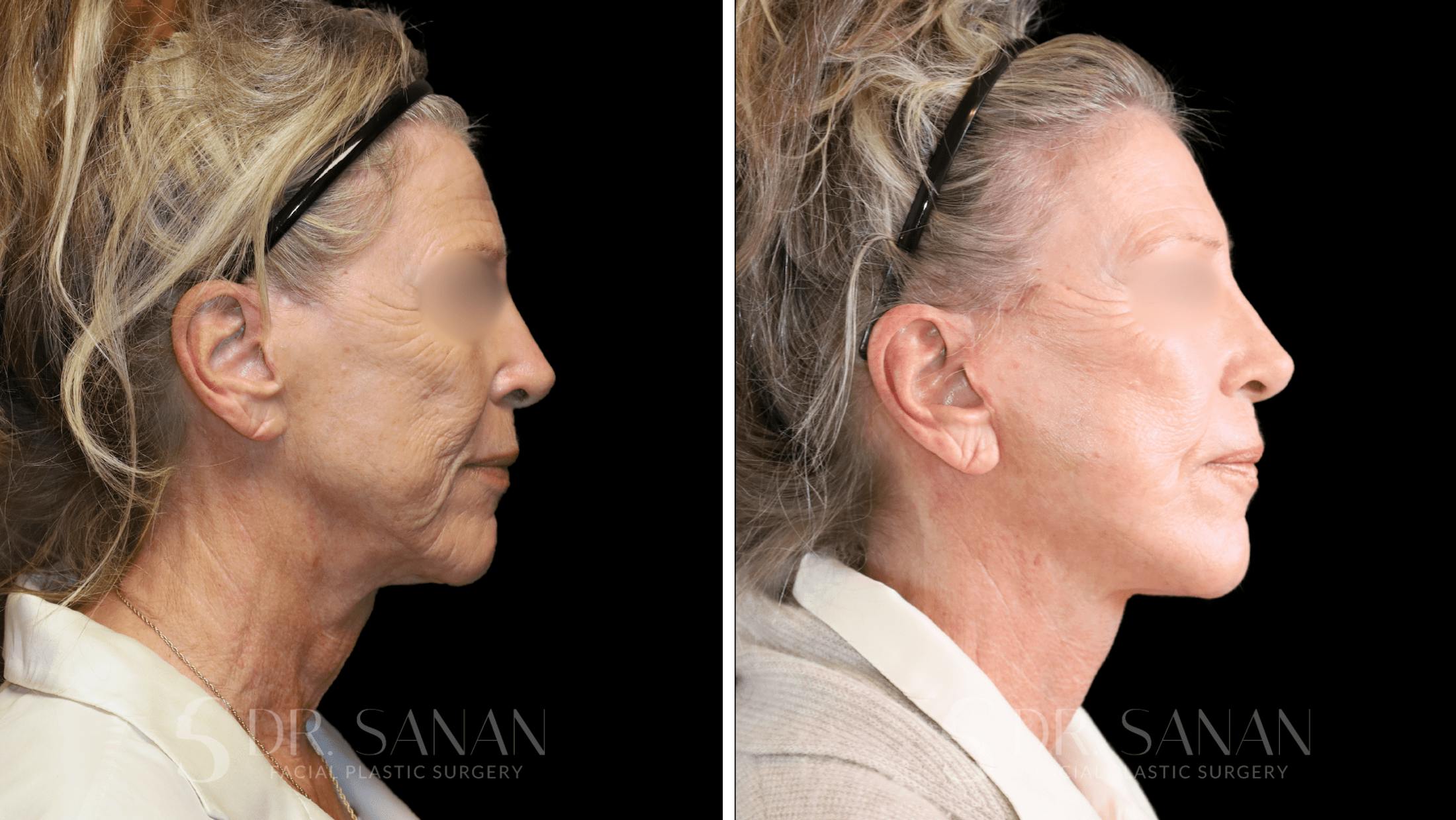 Neck Lift Before & After Gallery - Patient 102262 - Image 3