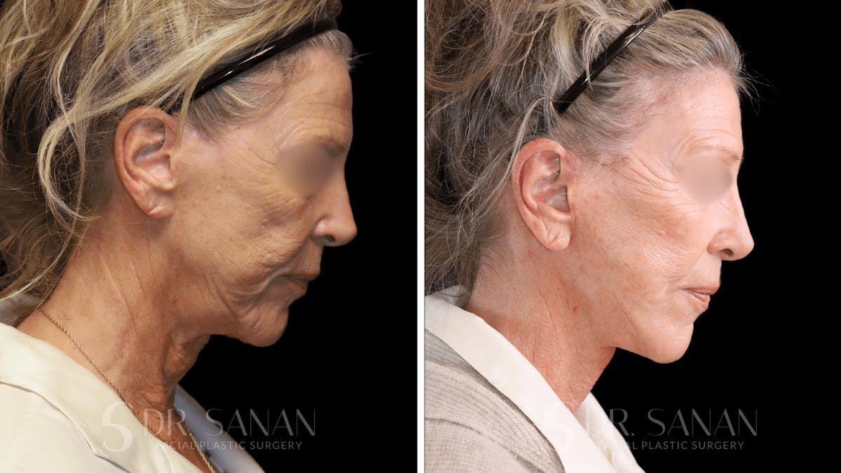 Neck Lift Before & After Gallery - Patient 102262 - Image 4