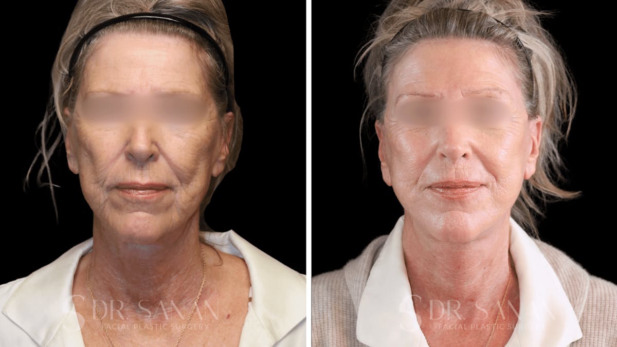 Neck Lift Before & After Gallery - Patient 102262 - Image 1