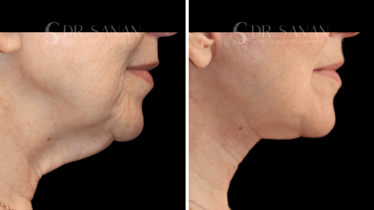 Neck Lift Before & After Gallery - Patient 276137 - Image 3