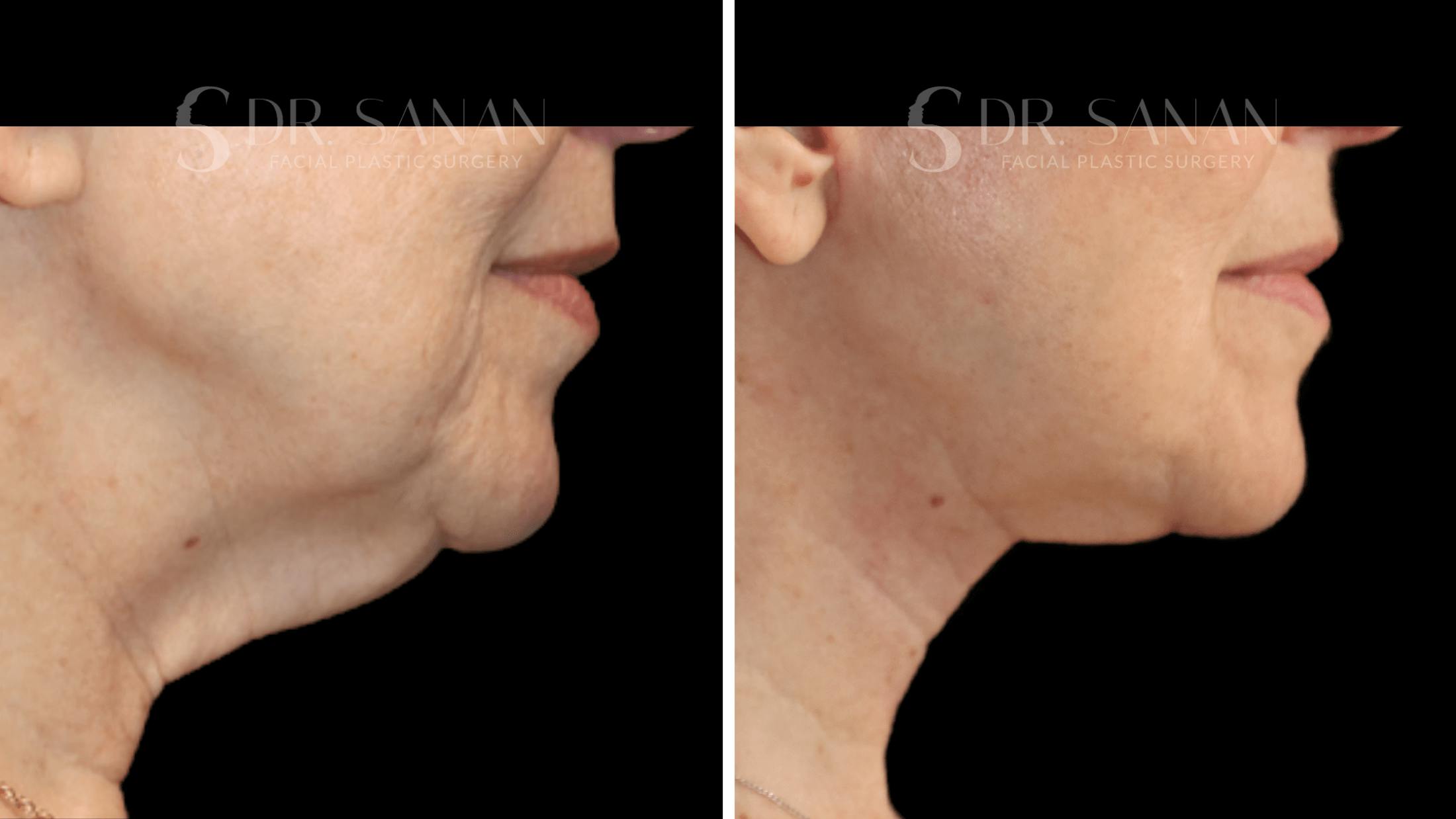 Neck Lift Before & After Gallery - Patient 276137 - Image 3