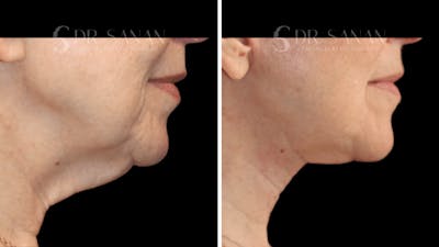 Deep Plane Facelift Before & After Gallery - Patient 383772 - Image 1