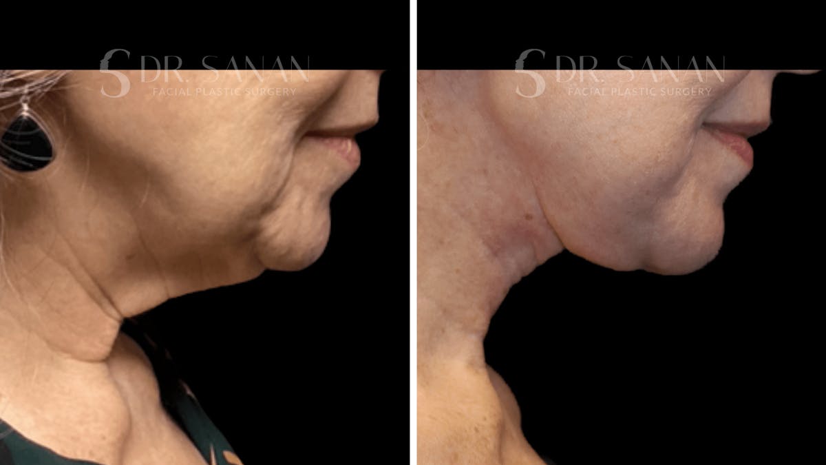 Neck Lift Before & After Gallery - Patient 276137 - Image 4